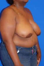 Breast Reduction