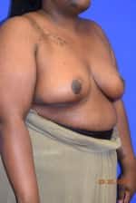 Breast Reduction