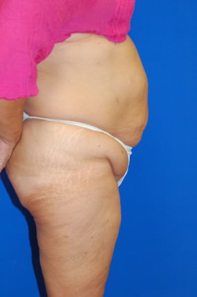 Tummy Tuck