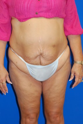 Tummy Tuck