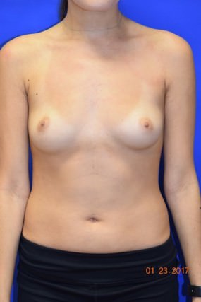 Breast Augmentation