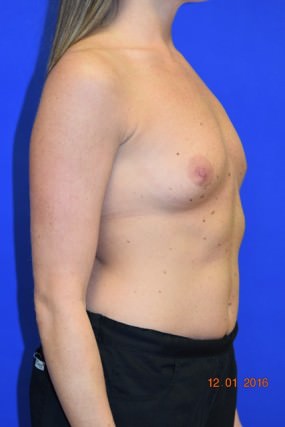 Breast Augmentation