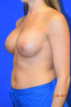 Breast Augmentation