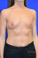 Breast Augmentation