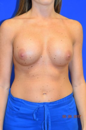 Breast Augmentation