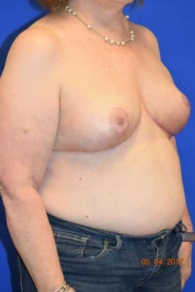 Breast Reduction