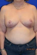 Breast Reduction