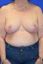 Breast Reduction