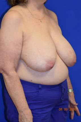 Breast Reduction