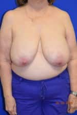 Breast Reduction
