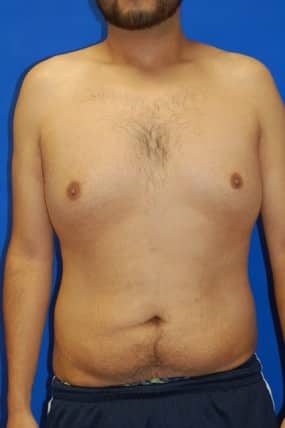 Male Breast Reduction