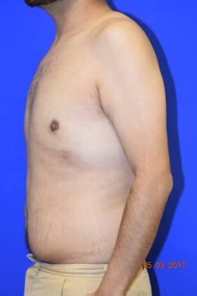 Male Breast Reduction