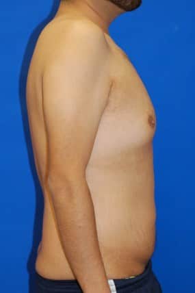 Male Breast Reduction