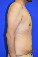 Male Breast Reduction