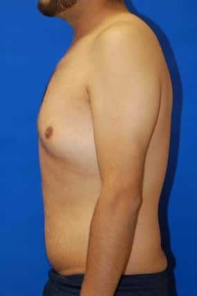 Male Breast Reduction