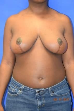 Breast Reduction