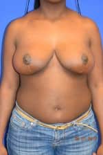 Breast Reduction