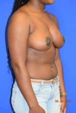 Breast Reduction
