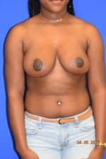 Breast Reduction