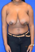 Breast Reduction