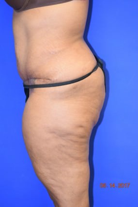 Tummy Tuck