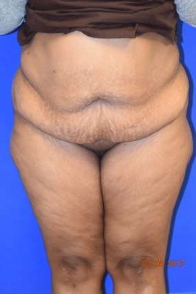 Tummy Tuck