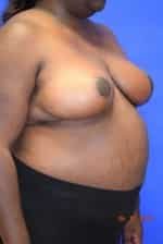 Breast Reduction