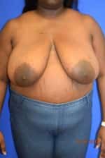 Breast Reduction