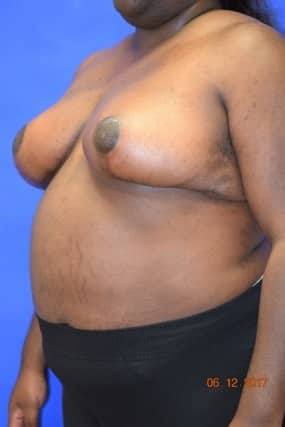 Breast Reduction