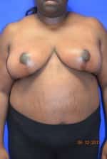 Breast Reduction