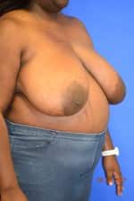 Breast Reduction