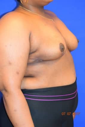 Breast Reduction