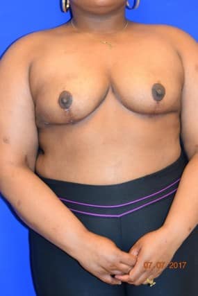 Breast Reduction