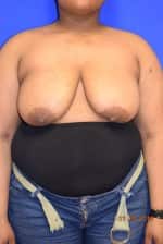 Breast Reduction