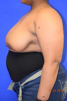 Breast Reduction