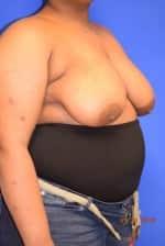 Breast Reduction