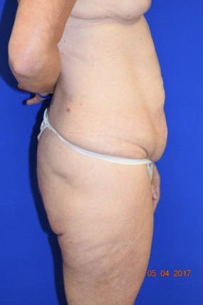 Tummy Tuck