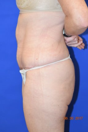 Tummy Tuck