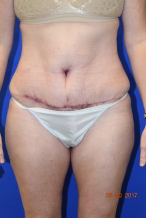 Tummy Tuck