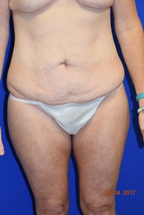 Tummy Tuck