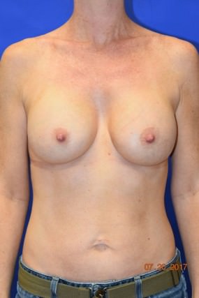 Breast Augmentation Case 6034 – Silicone breast aug After Photo Breast Augmentation