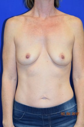 Breast Augmentation Case 6034 – Silicone breast aug Before Photo Breast Augmentation