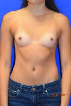 Breast Augmentation