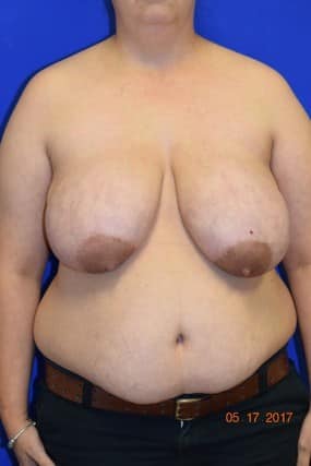 Breast Reduction