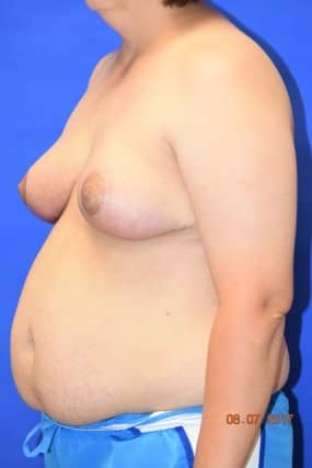 Breast Reduction