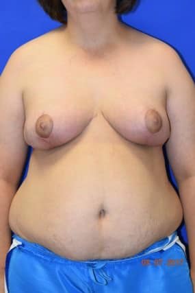 Breast Reduction