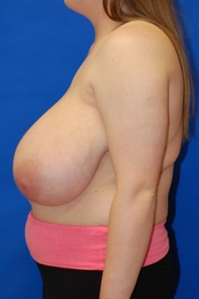 Breast Reduction