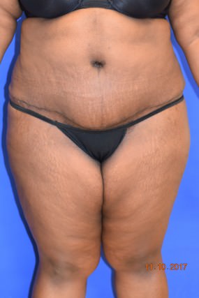 Tummy Tuck