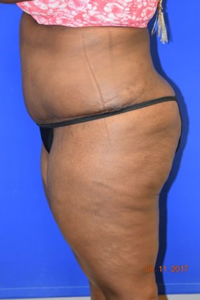 Tummy Tuck