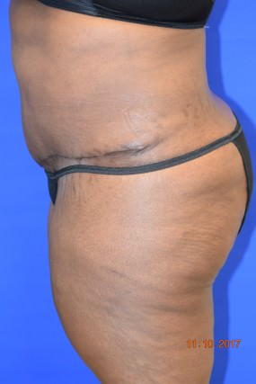 Tummy Tuck